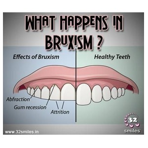 What is Bruxism?